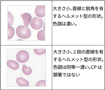 表2 破砕赤血球の形態学的特徴の記載例 〔日本検査血液学会：破砕赤血球形態標準化案 第1.1版．2025より〕