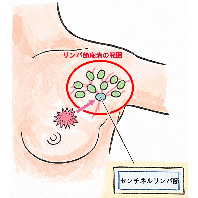 図　センチネルリンパ節