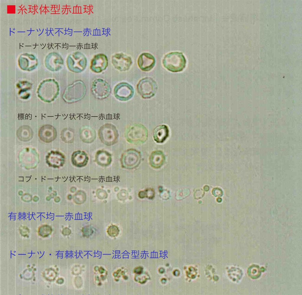 図　糸球体型赤血球 〔日本臨床検査標準協議会（JCCLS）尿沈渣検査標準化委員会：尿沈渣検査法2010．日本臨床衛生検査技師会，2011より〕