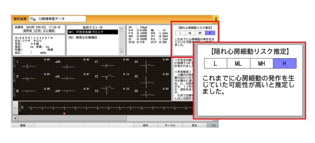 図1　洞調律時心電図から潜在的な心房細動リスクを推定