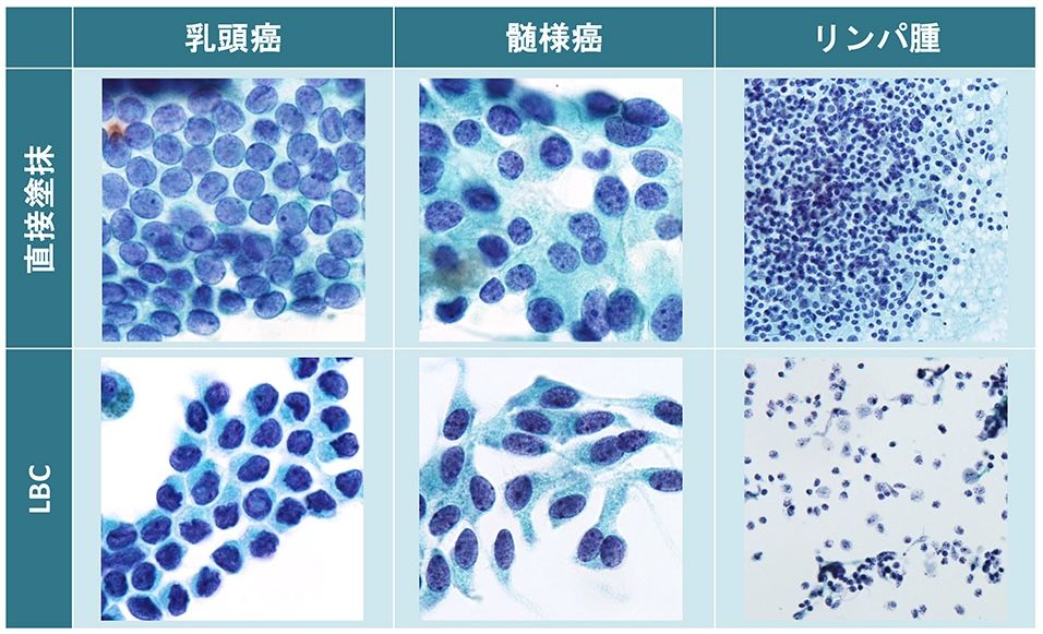 甲状腺細胞診の直接塗抹標本とLBCの比較