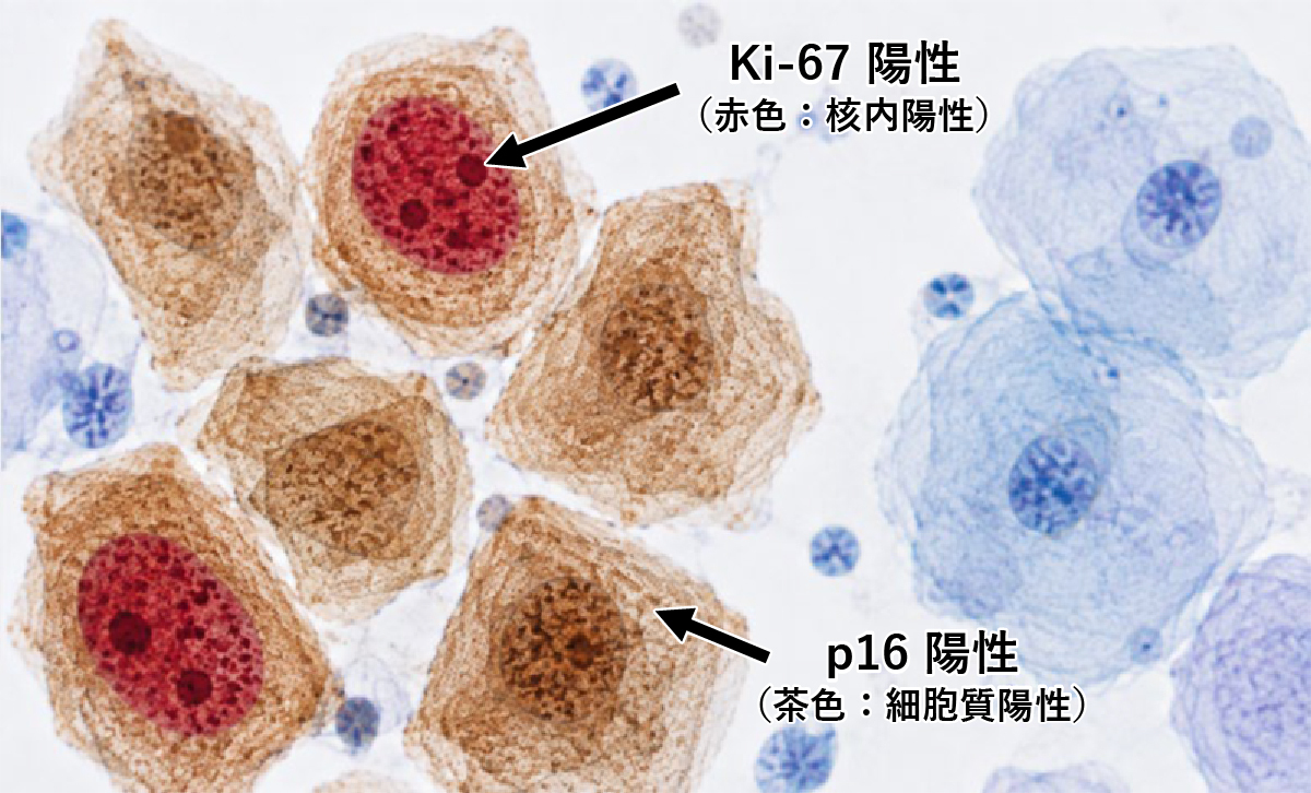 図2　p16Ki-67二重免疫染色の染色像筆者作成